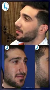 رضایت بیمار چهل و پنج روز بعد از جراحی زیبایی بینی