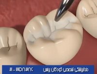 شیارپوش دندان | شیاربندی دندانها | فیشور سیلنت