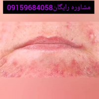 اگزما چیست؟ وچطوردرمانش کنیم؟