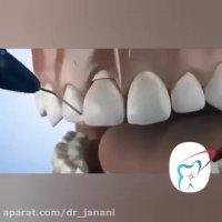 جراحی پیوند لثه