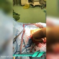 فیلم عمل تعویض مفصل لگن