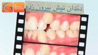 قبل و بعد ارتودنسی دندان نیش بیرون زده | دکتر مسعود داوودیان