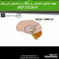 عوامل ایجاد و علائم پارکینسون چیست؟؟ درمان جدید بیماری پارکینسون