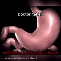 جراحی اسلیو معده