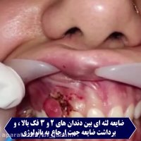برداشتن ضایعه دندانی