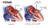 تنگی دریچه آئورت در بزرگسالان