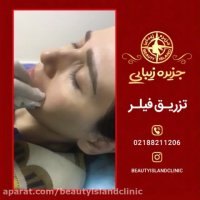 تزریق فیلر در کلینیک جزیره زیبائی