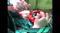 اصلاح پرانتزی پا حین تعویض مفصل زانو