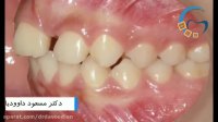 قبل و بعد ارتودنسی ثابت | دکتر مسعود داوودیان