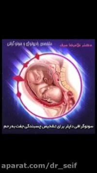 چسبندگی داپلر برای تشخیص چسبندگی جفت به رحم