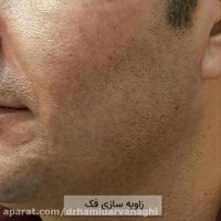 فیلم زاویه سازی فک با تزریق فیلر