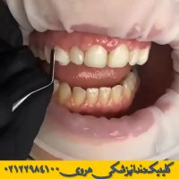 درمان نامرتبی دندان ها و نامرتبی لثه ای