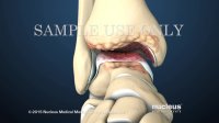 Total Ankle Replacement Surgery | Nucleus Health