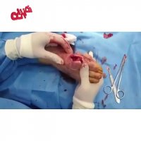 نجات پای دیابتی از قطع شدن توسط متخصصین دکتر زخم