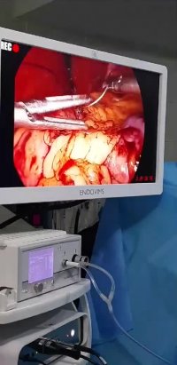 لایو اینستاگرام : جراحی چاقی اسلیوگاسترکتومی در خانم 31 ساله