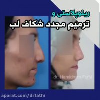 جراحی بینی و ترمیم شکاف لب