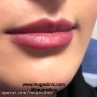 فیلم تزریق ژل به لب