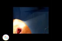 جایگذاری ایمپلنت و بازسازی همزمان استخوان