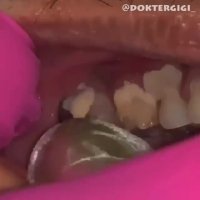 جرمگیری دندان