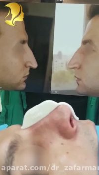 جراحی زیبایی بینی بلافاصله بعد از عمل