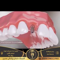 ایمپلنت یک روزه