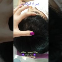 اسکالپ راه حلی قطعی برای رفع کم پشتی موها
