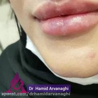 فیلم نمونه واقعی تزریق فیلر لب - مدل ترکیبی