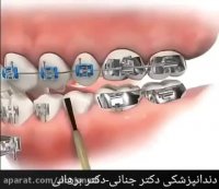 موارد آسیب زا به ارتودنسی دندان