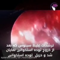 استئوم سینوس فرنتال(پولیپ بینی و سینوزیت)