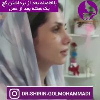 فیلم برداشتن گچ بینی یک هفته پس از جراحی