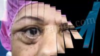 خارج کردن تومور از کاسه چشم بیمار 60 ساله