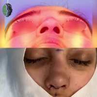 3 هفته بعد از جراحی بینی استخوانی | دکتر باستانی نژاد | جراح بینی تهران