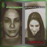 جراحی ترمیمی سوم بینی | دکتر باستانی نژاد | جراح بینی تهران