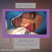 جراحی شکستگی کف چشم