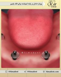 پروتز کامل دندان بر پایه ایمپلنت | دندانپزشکی سیمادنت