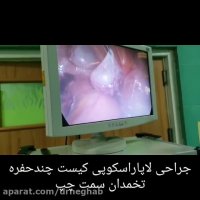 جراحی لاپاراسکوپی کیست تخمدان