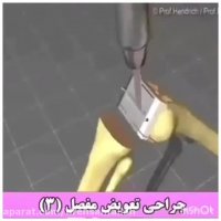 فیلم جراحی تعویض مفصل