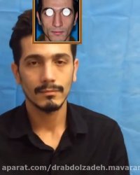 جراحی بینی بعد از یک ماه