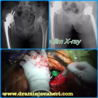 عمل جراحي تعويض كامل مفصل لگن از طريق روش آنتريور