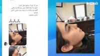 فیلم جراحی بینی بعد از 6 روز