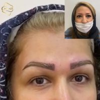کاشت ابرو طبیعی در سعادت آباد