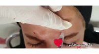 فیلم تزریق بوتاکس به پیشانی