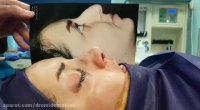 جراحی بینی گوشتی قوزدار توسط دکتر امید ابراهیمی بهترین جراح بینی