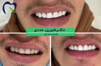 8 واحد کامپوزیت فک بالا