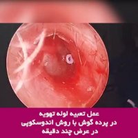 عمل ترمیم پرده گوش تعبیه لوله تهویه در آن
