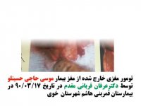 جراحی تومور مغزی