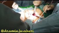 ویدیو جراحی تعویض مفصل لگن توسط جراح امین جواهری