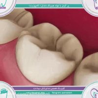 پرکردن دندان با مواد همرنگ دندان (کامپوزیت)| سیمادنت