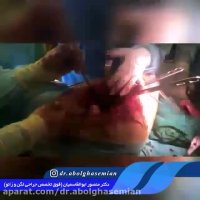 فیلم درمان تومور لگن