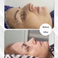 نمونه جراحی بینی دکتر علی طاهری نیا